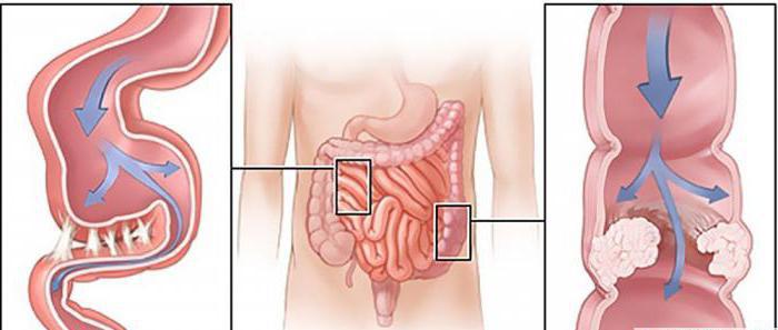 beker op het Röntgenogram