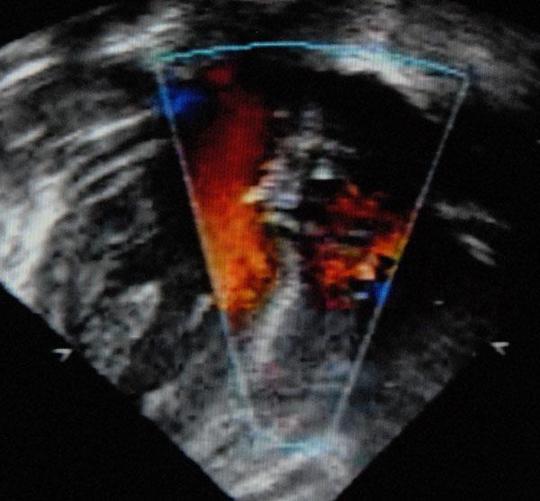Bijkomend akkoord van de linker ventrikel - wat is het?