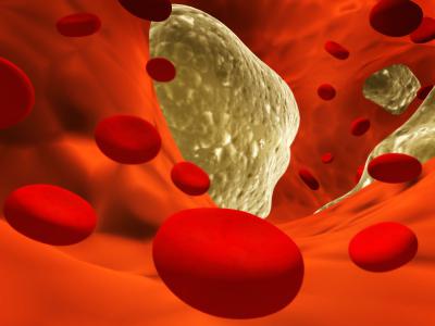 LDL-cholesterol verhoogd