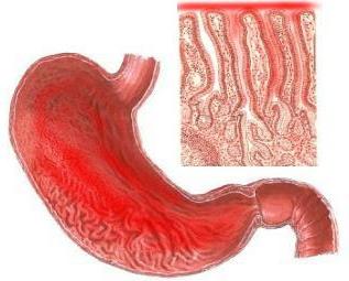 catarrale gastritis