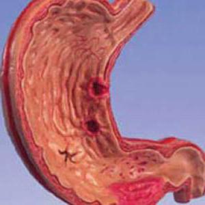 code voor microbiële 10 eroderende gastritis