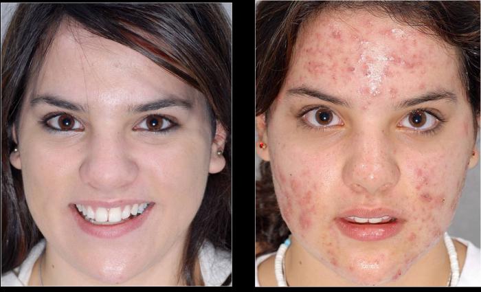 Rosec van acne beoordelingen 