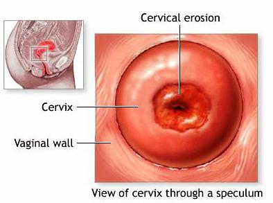 Kan ik zwanger worden van cervicale erosie?