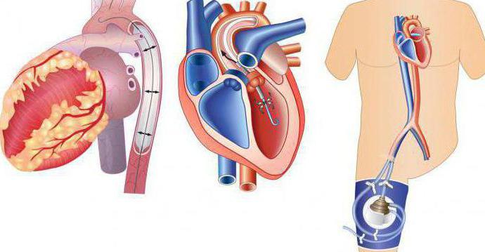 overlijden door cardiogene shock