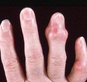 Reumatoïde artritis foto's