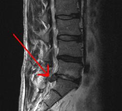 uitsteeksel van de wervelkolom van de lumbale wervelkolom