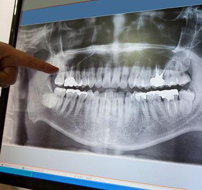 X-ray van de kaak: getuigenis, waar te doen, beschrijving van de procedure