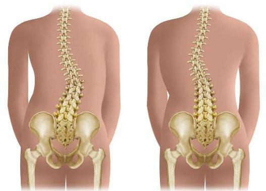 coliose van de wervelkolom van de eerste graad