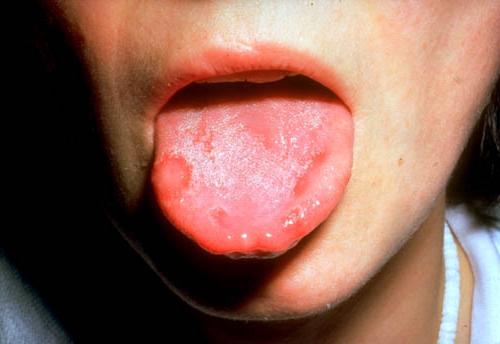 Stomatitis bij kinderen: symptomen en behandeling