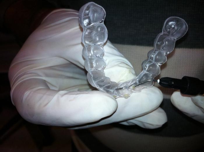 Tanduitlijning in orthodontie